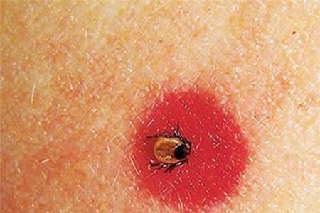 跳蚤咬的症状