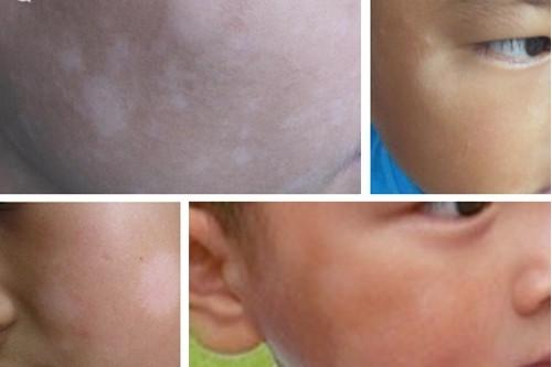 看看你家孩子脸上有这种白斑吗？
