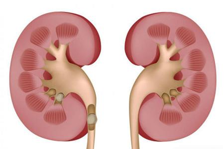 肾盂分离是什么意思