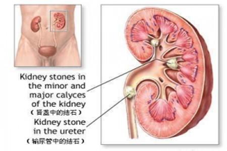 肾盂分离的原因是什么
