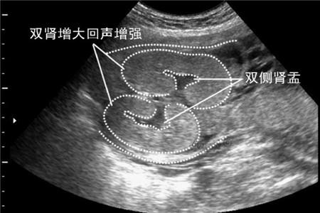 肾盂分离对胎儿的影响