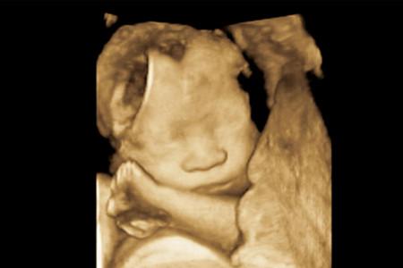 寶寶的第一張照片——三維彩超，讓你一分鐘就看得懂！