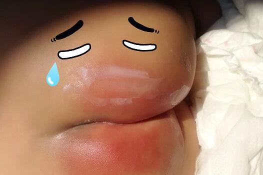 宝宝纸尿裤过敏是怎么回事