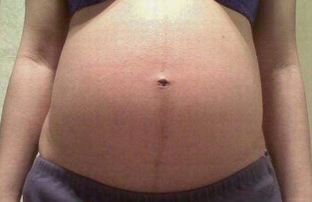 怀孕后，肚皮上出现神秘黑线咋回事？