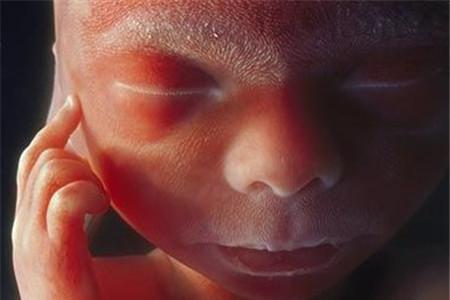 胎儿肾盂分离是畸形吗