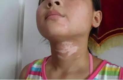 孩子脸上长白斑是因为有虫？忽视了这些细节，孩子遭大罪！