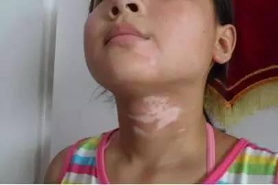 孩子脸上长白斑是因为有虫？忽视了这些细节，孩子遭大罪！