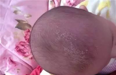 宝宝头垢多，千万别动手抠