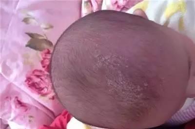 宝宝头垢多，千万别动手抠