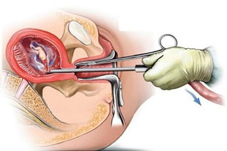 刮宫过程是怎样的