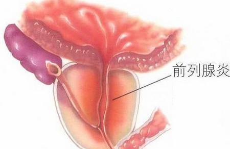 预防前列腺炎了吗？别让孕育能力一言难尽