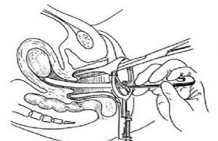 刮宫检查是什么意思