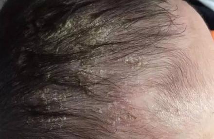 脂溢性皮炎一定是油光满面吗？