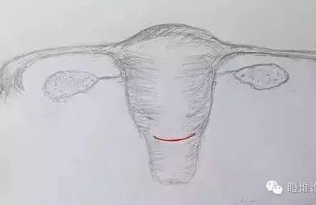 看图！产科医生画你知，剖宫产后为啥需要避孕？