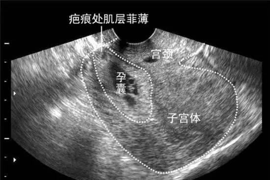 一胎剖宫产，二胎妈妈差点子宫破裂，瘢痕妊娠的风险不容忽视！