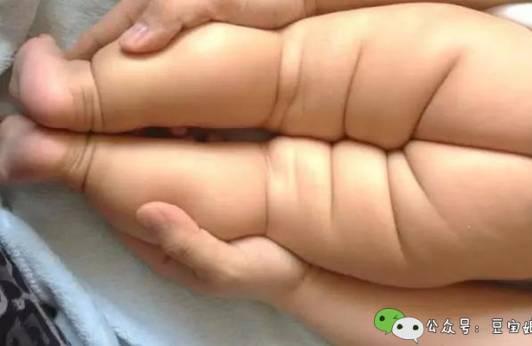 宝宝腿纹不对称？这可不能大意，会导致双腿长短不齐