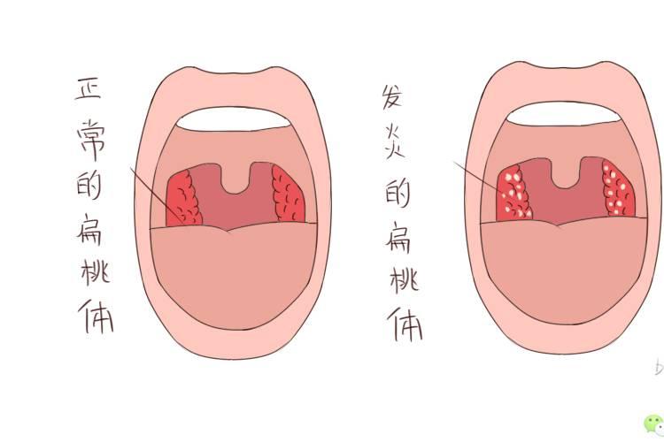 做个有心妈妈，冬季预防孩子扁桃体发炎