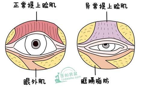 孩子眼睛小？有一种病叫上睑下垂