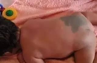 美貌与健康的“杀手”，如何正确辨别胎记 & 血管瘤？
