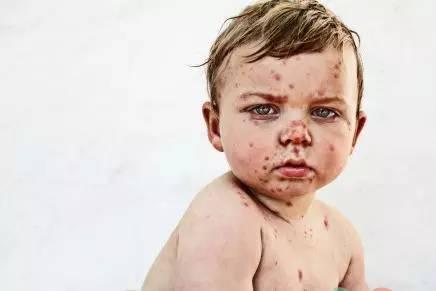 4个月宝宝出水痘，“凶手”竟然是妈妈！