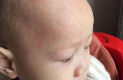 幼儿急疹 宝妈别慌张