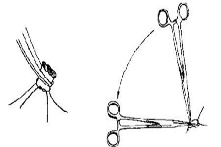 结扎后可以解扎吗