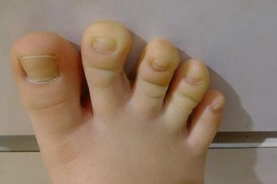 儿童脚趾甲凹陷是怎么回事