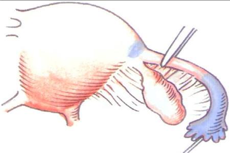  结扎复通术要开刀吗