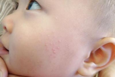 儿童脸颊两侧长小颗粒是怎么回事