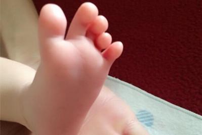 儿童脚外侧骨头突出是怎么回事