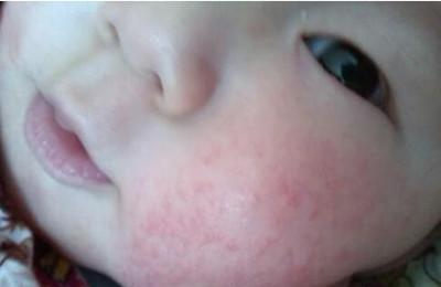 儿童脸红起红疹是怎么回事