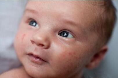儿童脸部过敏用什么药