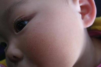 儿童脸皴了怎么办