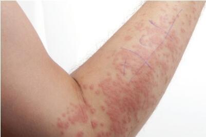 过敏性紫癜是什么病