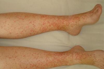 过敏性紫癜的症状