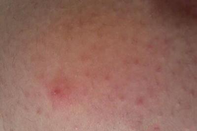 儿童艾滋病皮疹是什么样子的