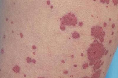 过敏性紫癜能治好吗