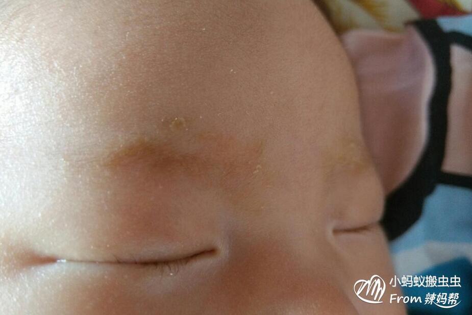 宝宝眉毛上有黄痂怎么办