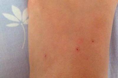 被跳蚤咬了怎么止痒