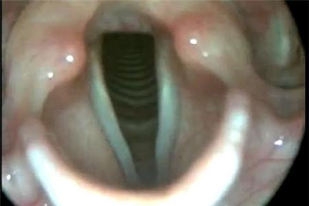 喉镜检查多少钱