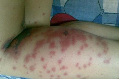 过敏性紫癜能自愈吗