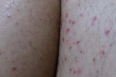 大腿上长了很多小红点