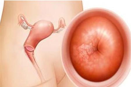 宫颈炎和宫颈癌的区别有哪些