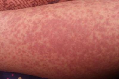 过敏性紫癜肾炎的症状