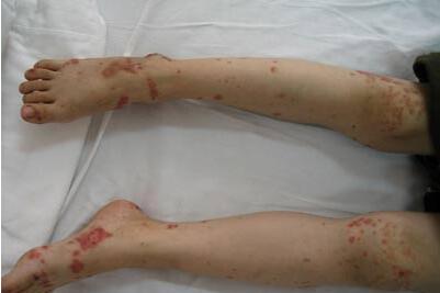 过敏性紫癜肾炎能治好吗