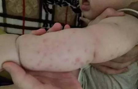 宝宝浑身小红疙瘩,原来是妈妈每天睡觉都做了这件事
