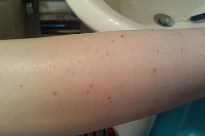 过敏性紫癜肾炎的治疗