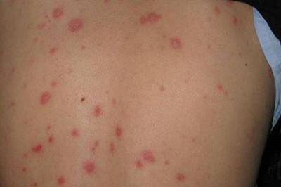 过敏性紫癜肾炎饮食禁忌