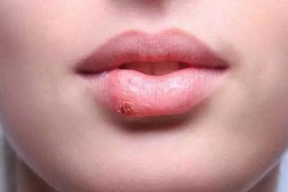 亲吻是会传播疱疹，那如何不让它威胁到你的宝宝？