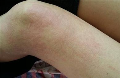过敏性荨麻疹症状